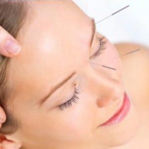 иглоукалывание