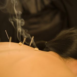 иглоукалывание и полынное прогревание